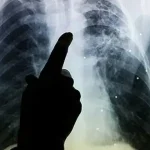 TB cases on the increase in Balochistan