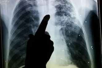 TB cases on the increase in Balochistan