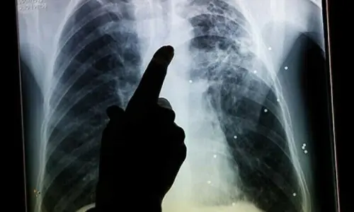 TB cases on the increase in Balochistan